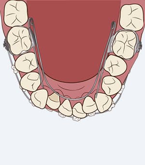 リンガルアーチ