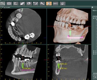 歯科用CT