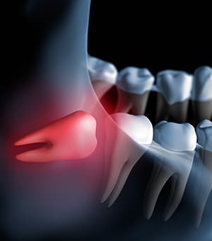 親知らずの抜歯