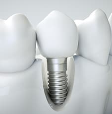 入れ歯・インプラント